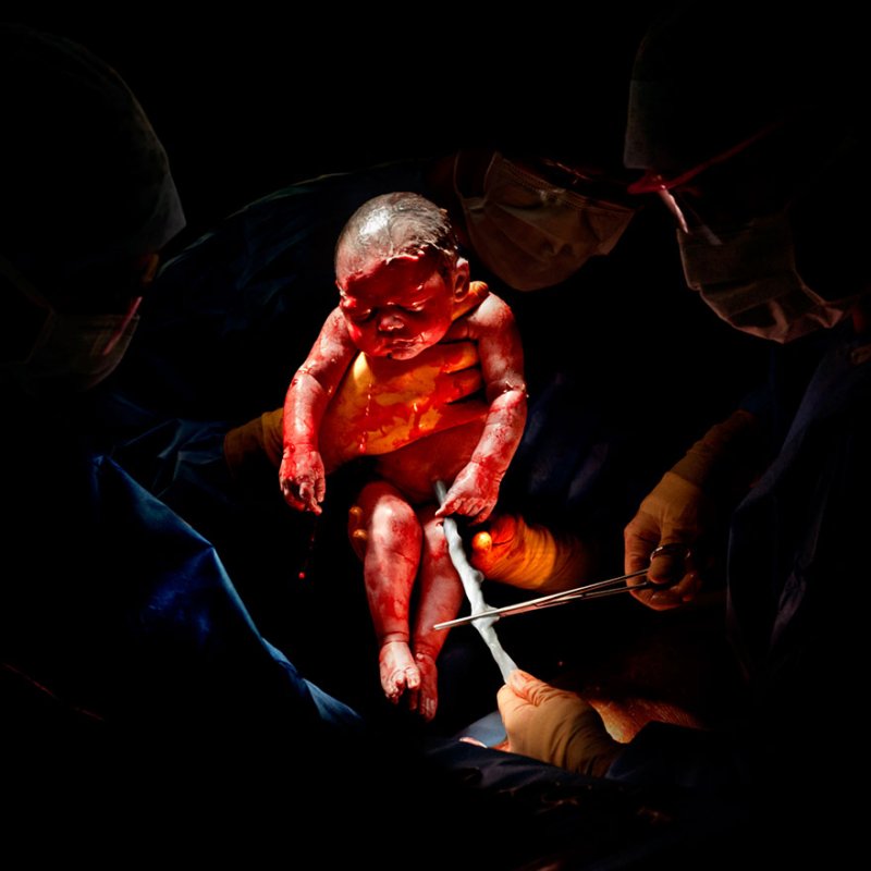 newborn-infant-photos-c-section-cesar-christian-berthelot-1